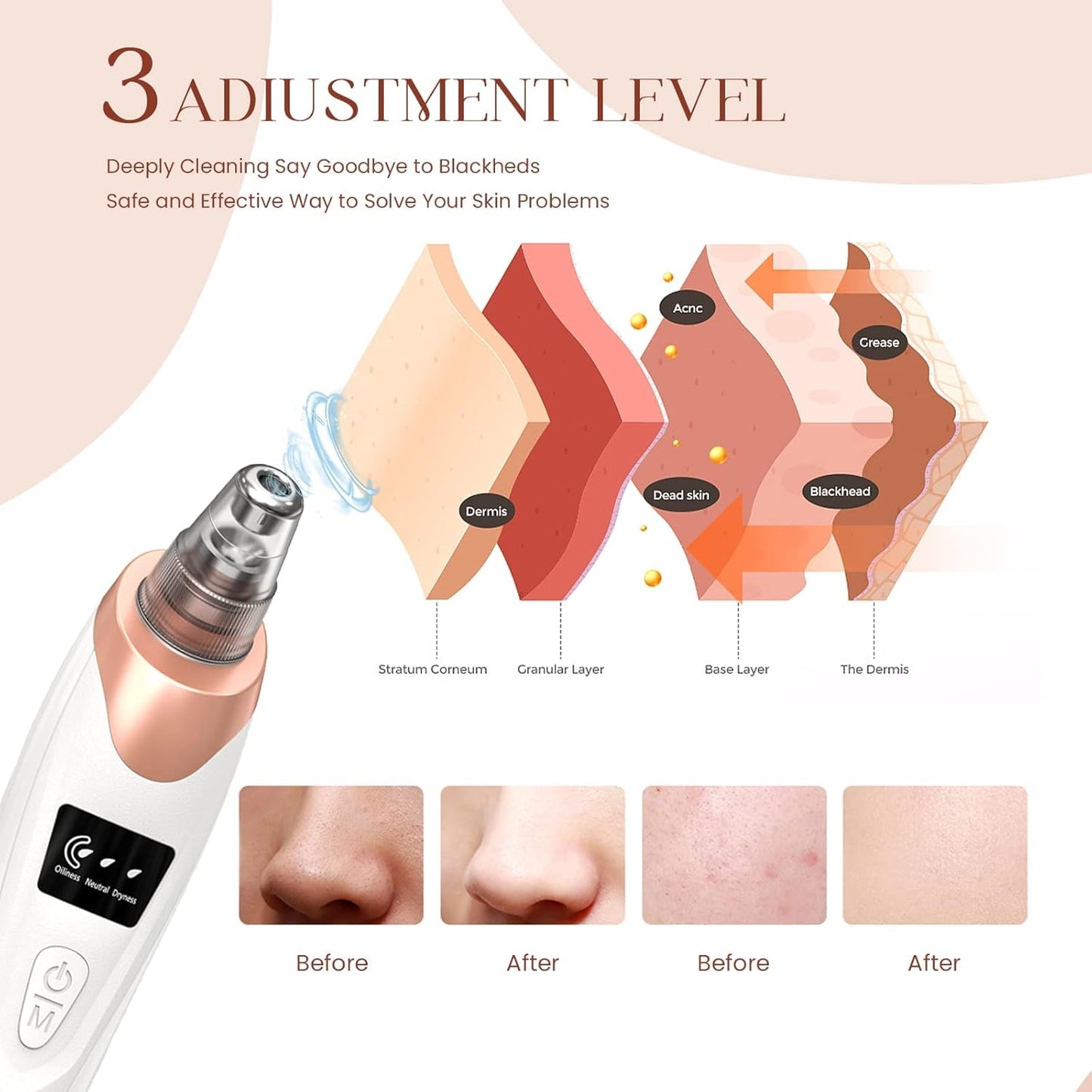 Blackhead Remover Pore Vacuum,Facial Pore Cleaner